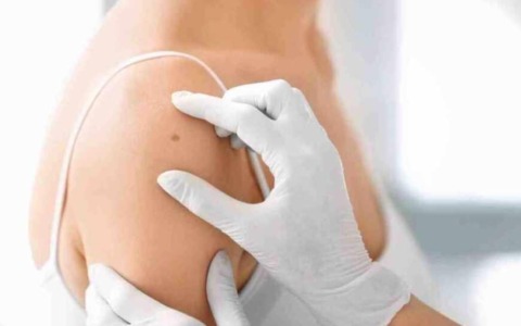 Alta incidenza di tumori cutanei a Torino e nuove proposte per i caregiver