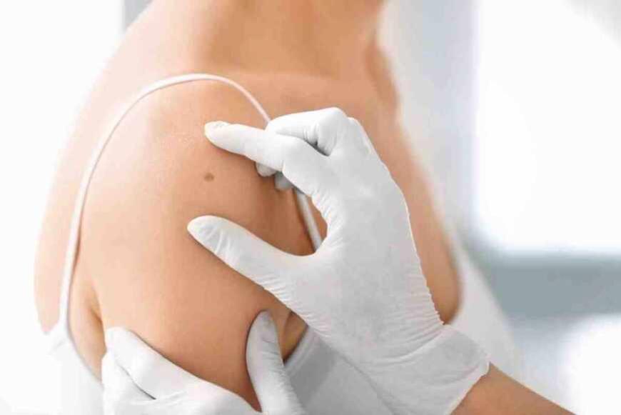 Alta incidenza di tumori cutanei a Torino e nuove proposte per i caregiver